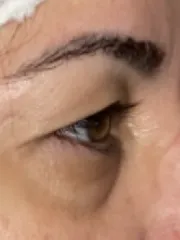 Before Bilateral upper eyelid blepharoplastywith eyelid repositioning left view