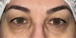 Before Bilateral upper eyelid blepharoplasty