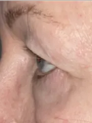 Before Bilateral upper eyelid blepharoplastywith right upper eyelid repositioning left view