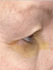 Before Bilateral upper eyelid blepharoplastywith right upper eyelid repositioning left view