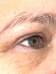 After Bilateral upper eyelid blepharoplasty witheyelid repositioning and internal brow fixation right view