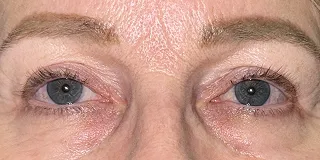 After Bilateral upper eyelid blepharoplastywith eyelid repositioning