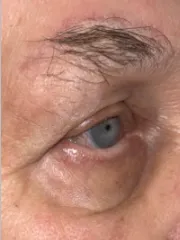 After Bilateral upper eyelid blepharoplastywith direct browplasty Left view