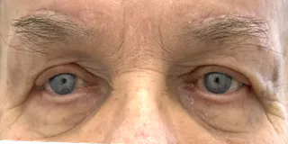 After Bilateral upper eyelid blepharoplastywith direct browplasty