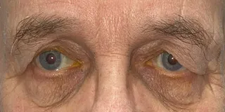 before Bilateral upper eyelid blepharoplastywith direct browplasty