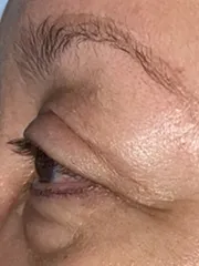 After Bilateral upper eyelid blepharoplasty with eyelid repositioning right view