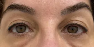 Before Laser-based skin resurfacing ofthe upper and lower lids