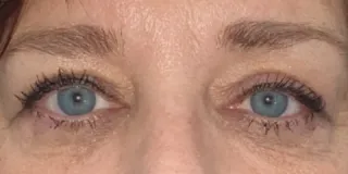 After Bilateral upper eyelid repositioning