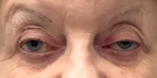 Before Bilateral upper eyelid blepharoplasty with eyelid repositioning