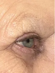 After Bilateral upper eyelid blepharoplasty with eyelid repositioning left view