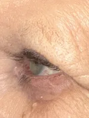 After Bilateral upper eyelid blepharoplasty with eyelid repositioning right view