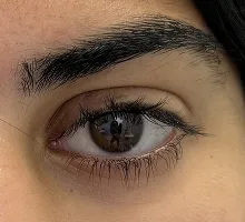 After Left upper lid chalazion incision and drainagewith corticosteroid injection