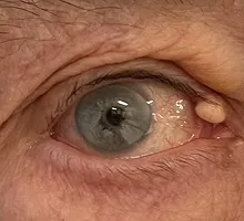 Before Right upper lid excision ofepidermal inclusion cyst