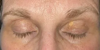 before Cosmetic excision of xanthelasma and reconstruction