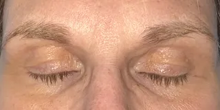 Cosmetic excision of xanthelasma and reconstruction