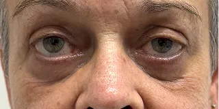 After Laser-based skin resurfacing of the upper and lower lids,treatment of festoons, and rosacea