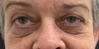 Before Laser-based skin resurfacing of the upper and lower lids,treatment of festoons, and rosacea