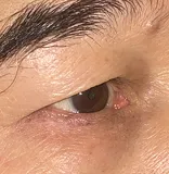 Post-op month 3 Right lower lid cosmetic nevus excision and reconstruction