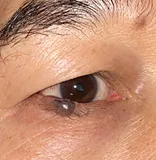 Before Right lower lid cosmetic nevus excision and reconstruction