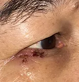 Post-op week 1 Right lower lid cosmetic nevus excision and reconstruction