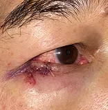 Immediately after Right lower lid cosmetic nevus excision and reconstruction