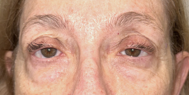 Upper and lower eyelid blepharoplasty with upper eyelid ptosis surgery Before