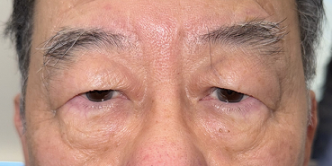 Before Upper eyelid sub-brow blepharoplasty with brow lift