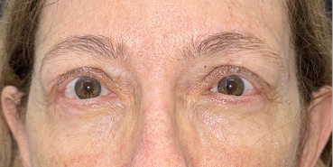 After Upper and lower eyelid blepharoplasty with upper eyelid ptosis surgery