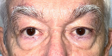 After Upper eyelid blepharoplasty with brow lift