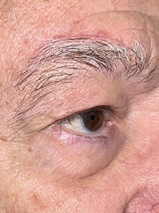 After Bilateral upper eyelid blepharoplasty witheyelid repositioning and internal brow fixation left view left view