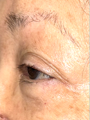 Before Bilateral upper eyelid blepharoplasty witheyelid repositioning and internal brow fixation left view