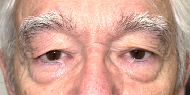 Before Upper eyelid blepharoplasty with brow lift