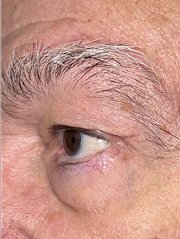 After Bilateral upper eyelid blepharoplasty witheyelid repositioning and internal brow fixation right view