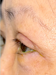After Bilateral upper eyelid blepharoplasty witheyelid repositioning and internal brow fixation right view