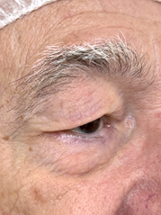 Before Bilateral upper eyelid blepharoplasty witheyelid repositioning and internal brow fixation left view