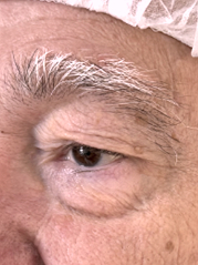 Before Bilateral upper eyelid blepharoplasty witheyelid repositioning and internal brow fixation left view
