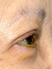 After Bilateral upper eyelid blepharoplasty witheyelid repositioning and internal brow fixation left view left view