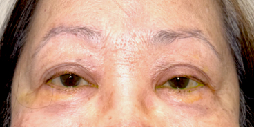 Before Upper eyelid ptosis repair with lid crease reformation