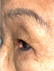 After Bilateral upper eyelid blepharoplasty witheyelid repositioning and internal brow fixation right view