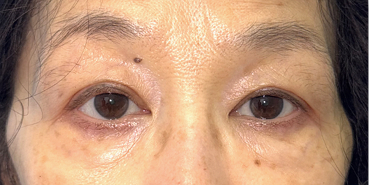 After Right upper eyelid ptosis surgery‍
