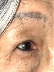 After Bilateral upper eyelid blepharoplasty witheyelid repositioning and internal brow fixation left view left view