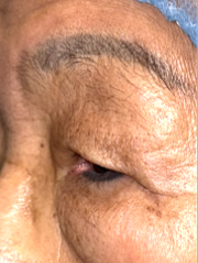 Before Bilateral upper eyelid blepharoplasty witheyelid repositioning and internal brow fixation left view
