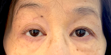 Before Right upper eyelid ptosis surgery‍