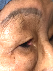 Before Bilateral upper eyelid blepharoplasty witheyelid repositioning and internal brow fixation left view