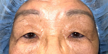 Before Upper eyelid blepharoplasty with lid crease reformation