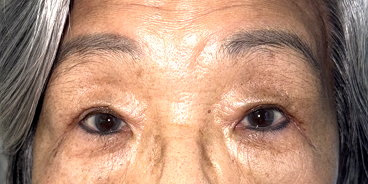 After Upper eyelid blepharoplasty with lid crease reformation