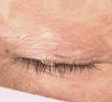 Before Excision of left upper lid seborrheic keratosis