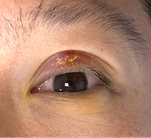 Before Left upper lid chalazion incision and drainage