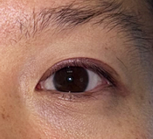 After Left upper lid chalazion incision and drainage