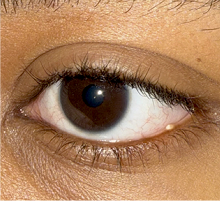 Before Excision of left lower lid margin milium cyst